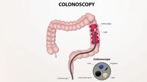 colonoscopy
